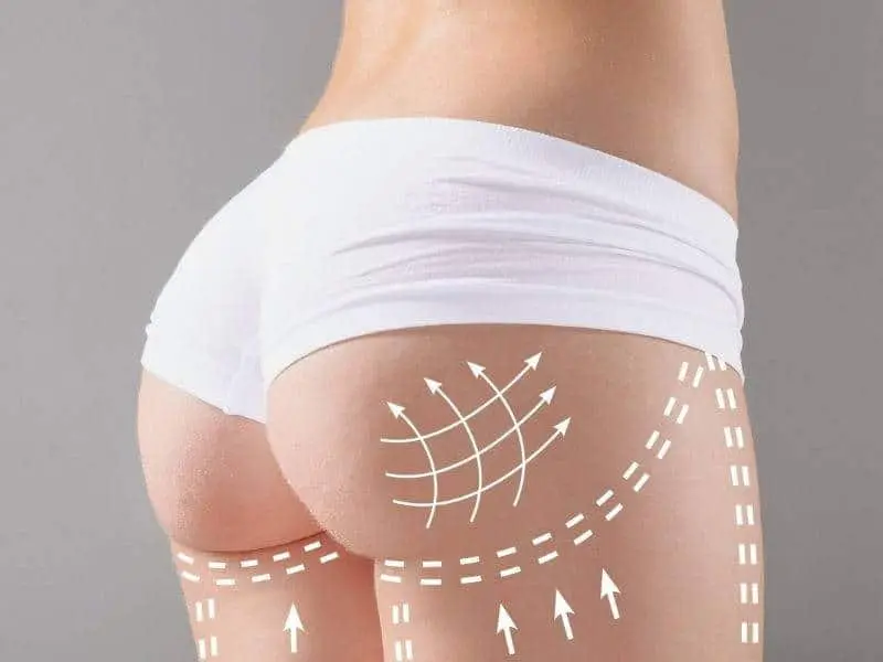 Brazilian Butt Lift